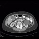 Porcelain gallbladder, calcification of gallbladder, cholecystolithiasis, gallstones: CT - Computed tomography